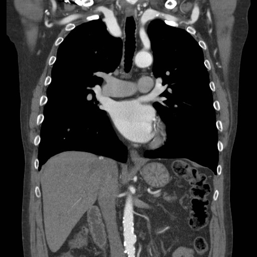 File:Coarctation of the aorta (Radiopaedia 17427-17116 A 46).jpg