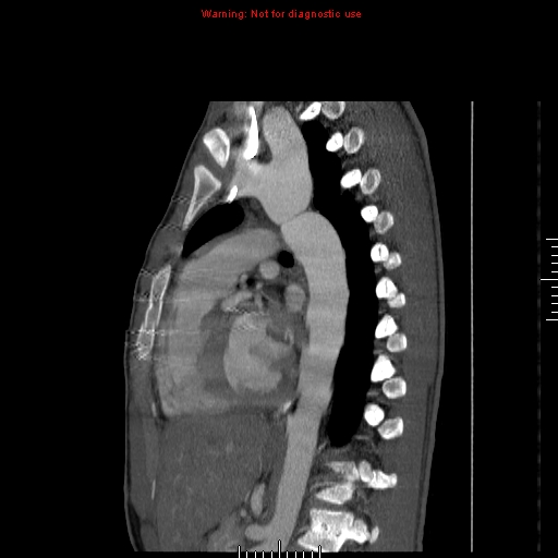 File:Coarctation of the aorta (Radiopaedia 9434-10118 B 35).jpg
