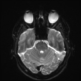 Cochlear incomplete partition type III associated with hypothalamic hamartoma (Radiopaedia 88756-105498 Axial DWI 13).jpg