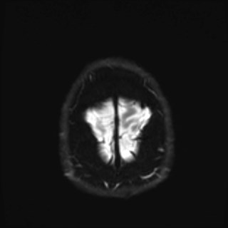File:Cochlear incomplete partition type III associated with hypothalamic hamartoma (Radiopaedia 88756-105498 Axial DWI 40).jpg