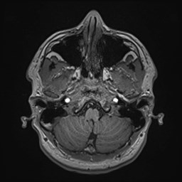 File:Cochlear incomplete partition type III associated with hypothalamic hamartoma (Radiopaedia 88756-105498 Axial T1 45).jpg