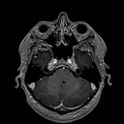 Cochlear incomplete partition type III associated with hypothalamic hamartoma (Radiopaedia 88756-105498 Axial T1 C+ 61).jpg
