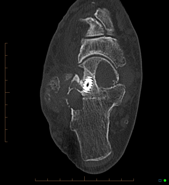 Collapsed total ankle replacement (Radiopaedia 17228-16932 Axial bone window 49).jpg