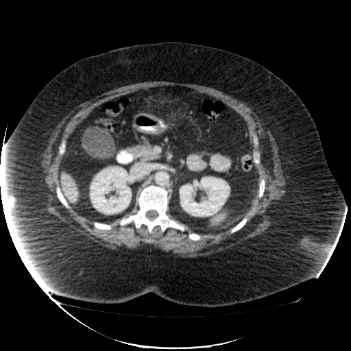 File:Collection due to leak after sleeve gastrectomy (Radiopaedia 55504-61972 A 33).jpg