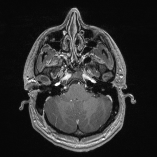 File:Colloid cyst (Radiopaedia 44510-48181 Axial T1 C+ 48).png