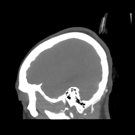 File:Colloid cyst (resulting in death) (Radiopaedia 33423-34499 B 11).png