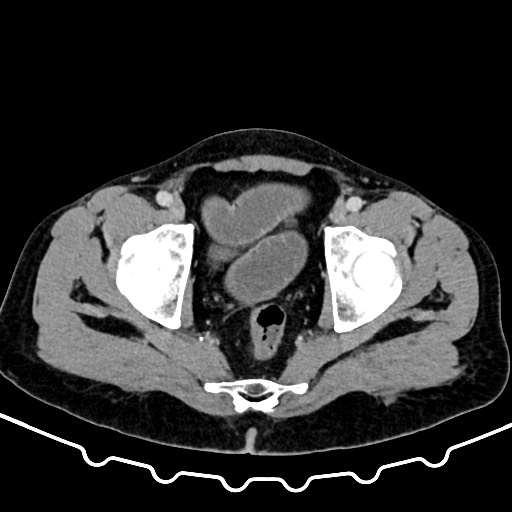 Colocolic intussusception due to large lipoma (Radiopaedia 68773-78482 A 175).jpg