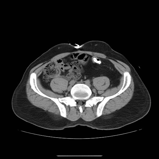 File:Colocutaneous fistula in Crohn's disease (Radiopaedia 29586-30093 D 22).jpg