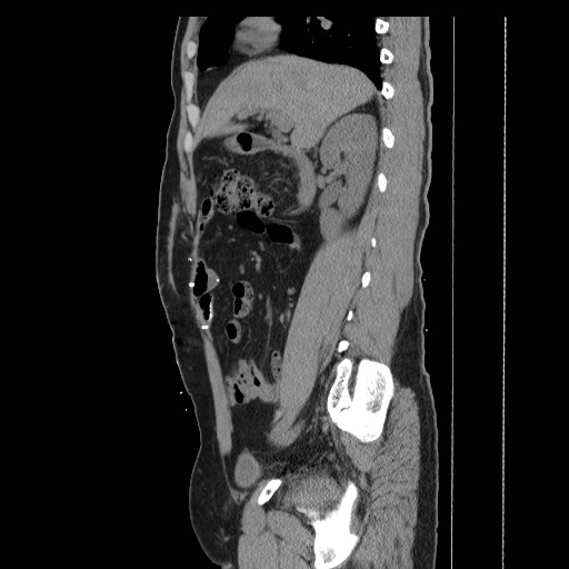 Colocutaneous fistula in Crohn's disease (Radiopaedia 29586-30093 F 3).jpg