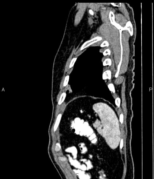 Colon adenocarcinoma (Radiopaedia 83266-97671 D 95).jpg