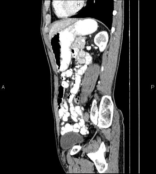 Colon adenocarcinoma - hepatic flexure (Radiopaedia 85635-101395 D 60).jpg