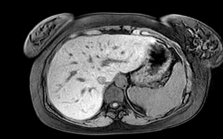 File:Colon adenocarcinoma with Krukenberg tumors, advanced pregnancy (Radiopaedia 67279-76645 A 68).jpg