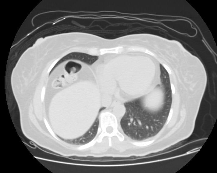 File:Colonic interposition (Radiopaedia 11322-11686 Axial lung window 1).jpg
