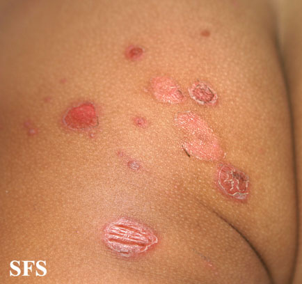 File:Impetigo (Dermatology Atlas 42).jpg