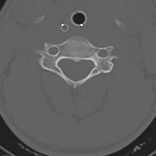 File:Multitrauma with diffuse axonal injury, temporal bone fractures and traumatic caroticocavernous fistula (Radiopaedia 37242-39035 Axial 181).png