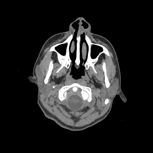 Nasal pyogenic granuloma (lobular capillary hemangioma) (Radiopaedia 85536-101244 Axial non-contrast 10).jpg