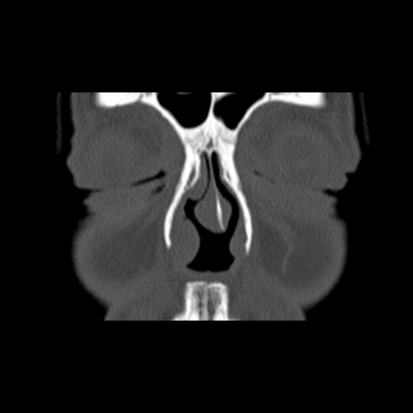 Nasal septal perforation (Radiopaedia 25030-25289 Coronal bone window 15).jpg