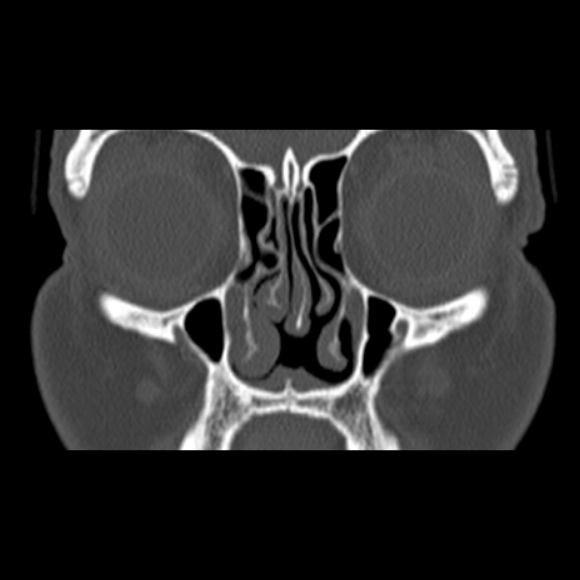 Nasal septal perforation (Radiopaedia 25030-25289 Coronal bone window 24).jpg