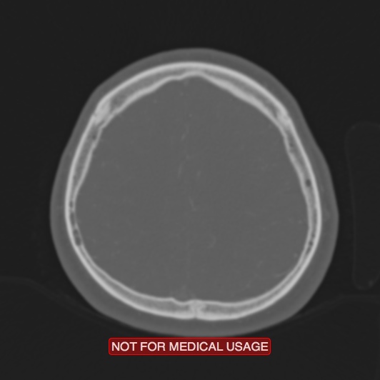 Nasopharyngeal carcinoma recurrence - skull base destruction (Radiopaedia 29107-29490 Axial bone window 26).jpg