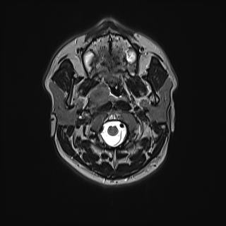 Nasopharyngeal carcinoma with perineural spread (Radiopaedia 55030-61380 Axial T2 31).jpg