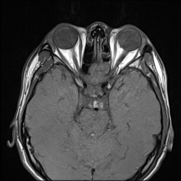 File:Nasopharyngeal carcinoma with skull base invasion (Radiopaedia 53415-59485 Axial T1 16).jpg