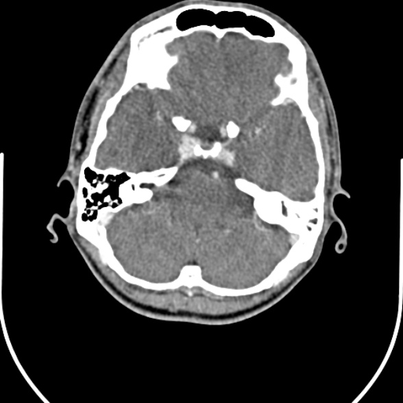 Nasopharyngeal carcinoma with skull base invasion (Radiopaedia 53415-59705 A 4).jpg