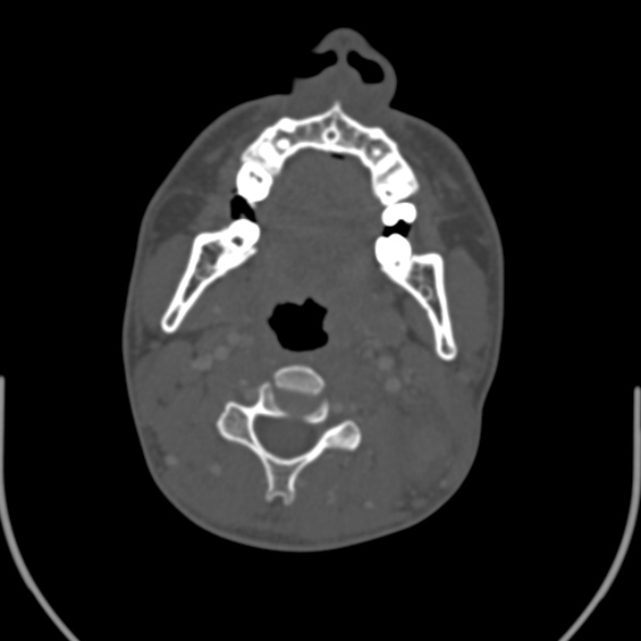 File:Nasopharyngeal carcinoma with skull base invasion (Radiopaedia 53415-59705 Axial bone window 97).jpg