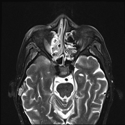 File:Nasopharyngeal carcinoma with skull base invasion (Radiopaedia 59258-66600 D 9).jpg