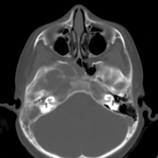 File:Nasopharyngeal rhabdomyosarcoma (Radiopaedia 23417-23491 Axial bone window 11).jpg
