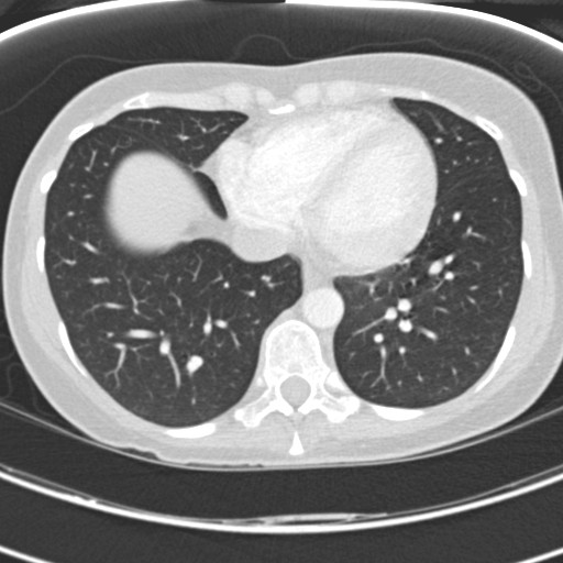 File:Necrobiotic pulmonary nodules - Crohn disease (Radiopaedia 20723-20631 Axial lung window 103).jpg