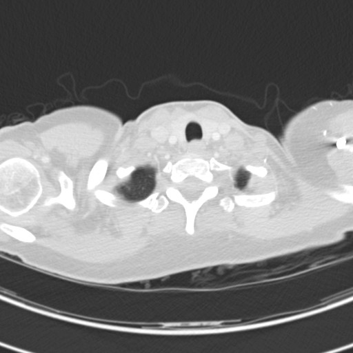 Necrobiotic pulmonary nodules - Crohn disease (Radiopaedia 20723-20631 Axial lung window 9).jpg