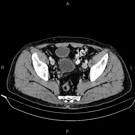 Necrotizing pancreatitis (Radiopaedia 87796-104249 A 50).jpg