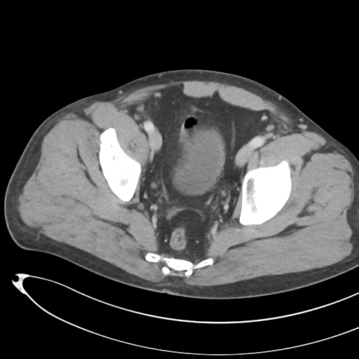 File:Necrotizing pancreatitis with acute necrotic collections (Radiopaedia 38829-41012 B 74).png