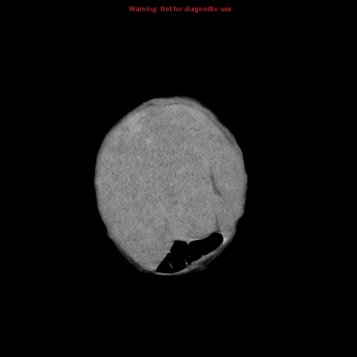 File:Neonatal neuroblastoma (Radiopaedia 9564-10223 B 16).jpg