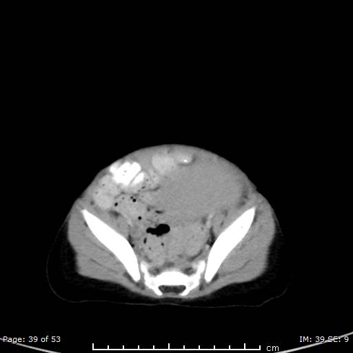 File:Nephroblastomatosis (Radiopaedia 41934-44935 A 39).jpg