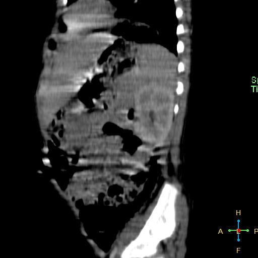 File:Neuroblastoma (Radiopaedia 24751-25016 C 7).jpg