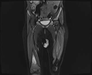 File:Neuroblastoma with bone metastases (Radiopaedia 67080-76414 Coronal STIR 8).jpg