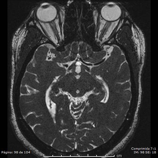 Neurocysticercosis (Radiopaedia 58636-65832 I 98).jpg