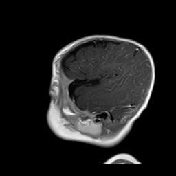 File:Neurofibromatosis type 1 (Radiopaedia 30089-30671 Sagittal T1 C+ 18).jpg