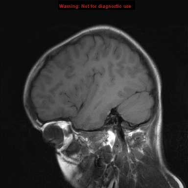File:Neurofibromatosis type 1 with optic nerve glioma (Radiopaedia 16288-15965 Sagittal T1 6).jpg