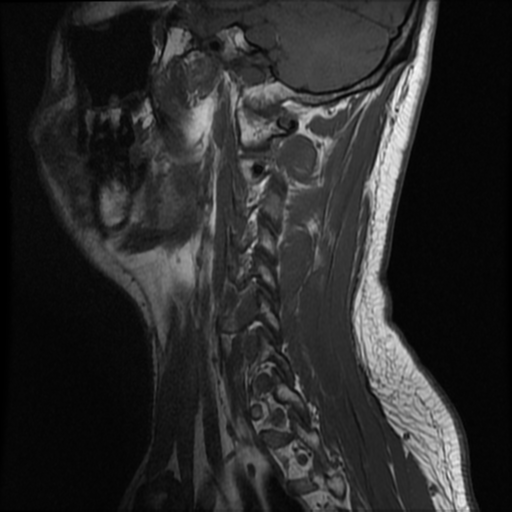 File:Neurofibromatosis type 2 (Radiopaedia 44936-48837 Sagittal T1 3).png