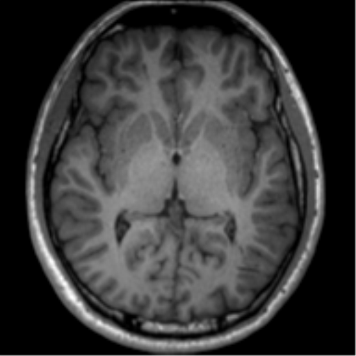 File:Neurofibromatosis type 2 (Radiopaedia 44936-48838 Axial T1 71).png