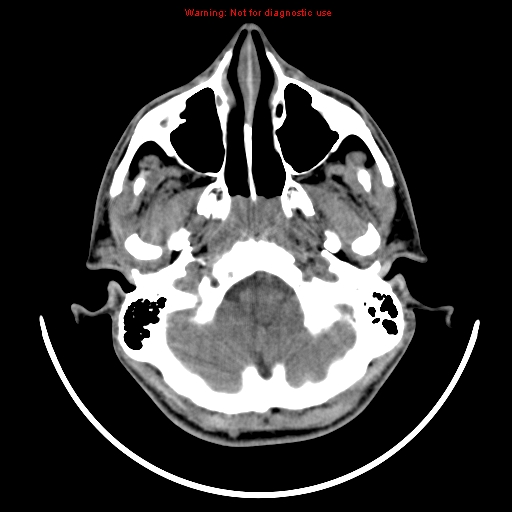 File:Neurofibromatosis type 2 (Radiopaedia 8953-9732 Axial non-contrast 3).jpg