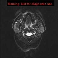 File:Neuroglial cyst (Radiopaedia 10713-11184 Axial DWI 23).jpg