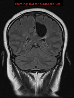 File:Neuroglial cyst (Radiopaedia 10713-11184 Coronal FLAIR 9).jpg