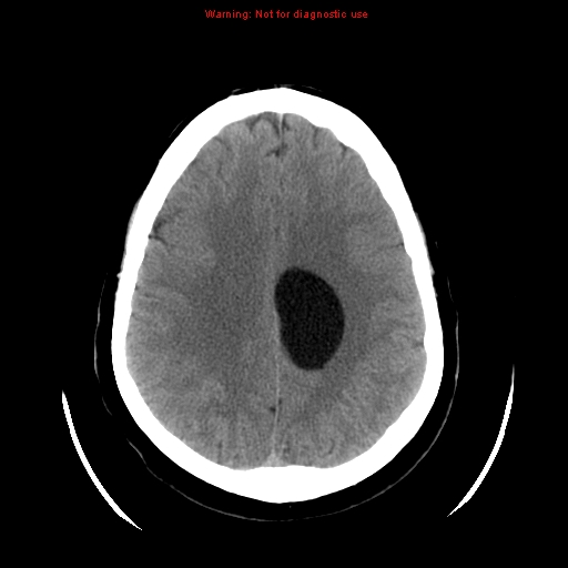 File:Neuroglial cyst (Radiopaedia 10713-11185 Axial non-contrast 11).jpg