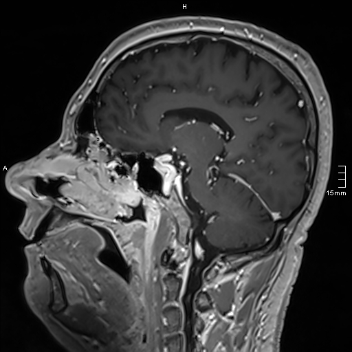 Neurosarcoidosis - involvement of the mesial temporal lobes (Radiopaedia 67429-76820 Sagittal T1 C+ 75).jpg