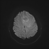 File:Neurotoxoplasmosis - concentric target sign (Radiopaedia 70644-80784 Axial DWI 18).jpg