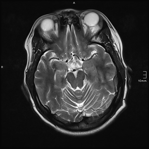 File:Neurotoxoplasmosis - concentric target sign (Radiopaedia 70644-80784 Axial T2 8).jpg