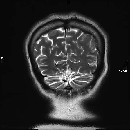 File:Neurotoxoplasmosis - concentric target sign (Radiopaedia 70644-80784 Coronal T2 11).jpg